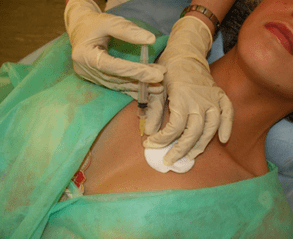 Въвеждане на мезококтейл в гръдната тъкан - алтернатива на инжекциите с хиалуронова киселина