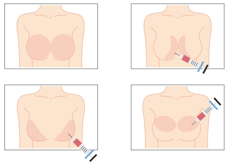 Места за инжектиране на хиалуронова киселина в гърдите
