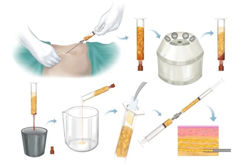 Отстраняване на мазнини от проблемните зони, обработка и инжектиране в гръдната тъкан