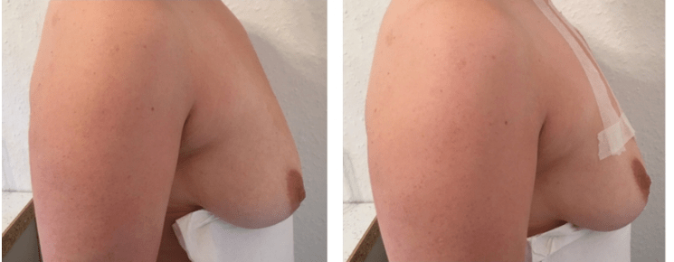 Преди и след повдигане на гърдите с конец